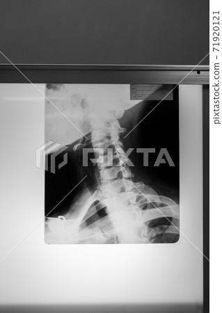 radiograph, x-ray photo, bone 71920121