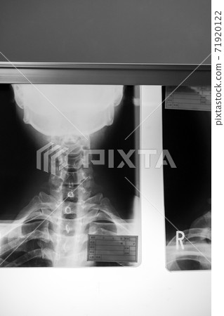 radiograph, x-ray photo, bone 71920122