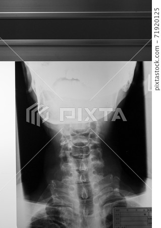 radiograph, x-ray photo, bone 71920125