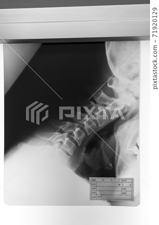 radiograph, x-ray photo, bone 71920129