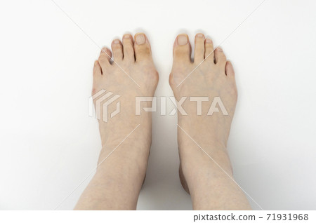 外翻腳趾(手指張開) 外翻腳趾(手指張開) 71931968