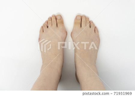 外翻腳趾(手指閉合) 外翻腳趾(手指閉合) 71931969