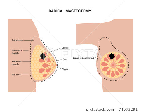 Breast disease concept 71973291