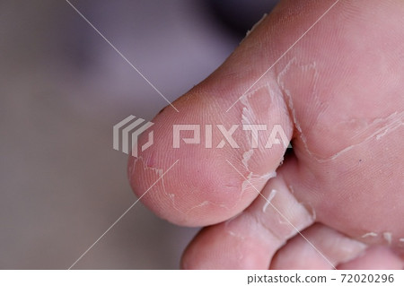 Big toe with peeling skin 72020296