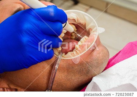 Dental practice, the dentist removes stones and hard plaque from the teeth with the help of ultrasound,patient with retractor and saliva ejector in the mouth. Dental practice, the dentist removes stones and hard plaque from the teeth with the help of ultrasound,patient with retractor and saliva ejector in the mouth. 72023087