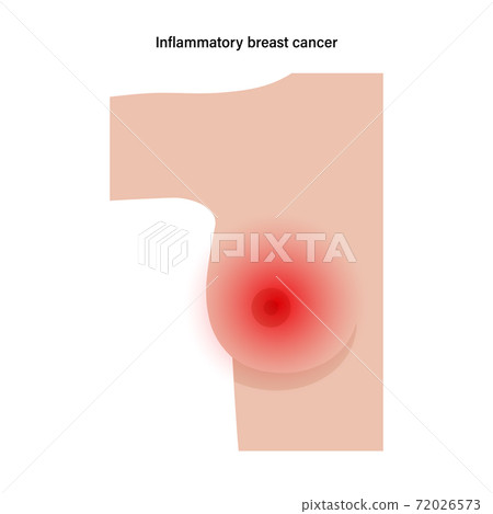 Breast disease concept Breast disease concept 72026573