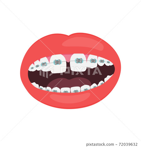 Open mouth with teeth braces isolated on white background vector illustration. Open mouth with teeth braces isolated on white background vector illustration. 72039632