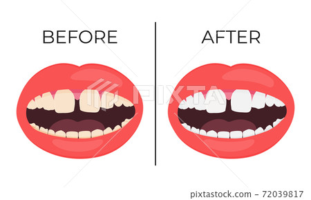 Lips with before and after view of whitening teeth Lips with before and after view of whitening teeth 72039817