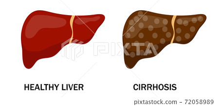 Illustration of healthy and diseased liver. Cirrhosis. Isolated art on white background. Vector. Cartoon. Flat. 72058989