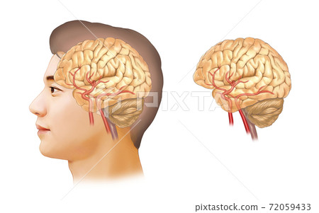 Cerebral aneurysm anatomy 72059433