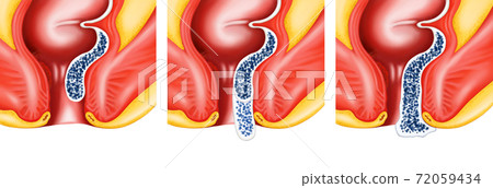 Anatomy of the hemorrhoid process 72059434