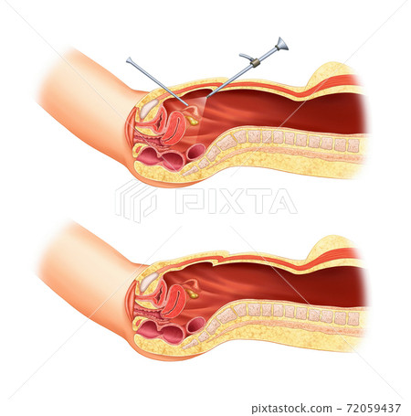 Laparoscopic surgery anatomy 72059437