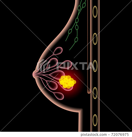 Breast disease concept Breast disease concept 72076975