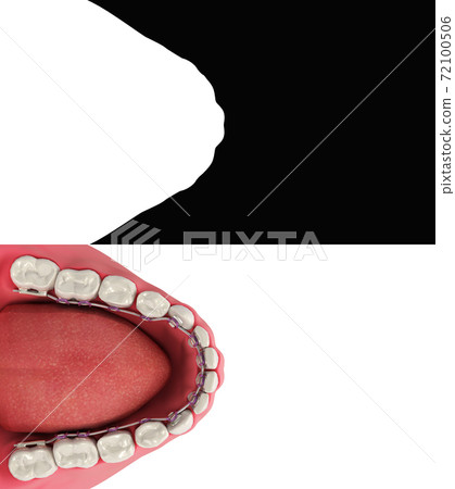 Lingual braces system on a demonstration denture 3d on wnite Alpha include 72100506