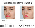 Wax, laser hair removal of the mustache for women 72126627