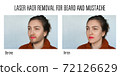 laser hair removal for beard and mustache 72126629
