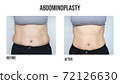 Abdominoplasty, tummy tuck plastic surgery in woman. Front view. Abdominal changes after pregnancy 72126630