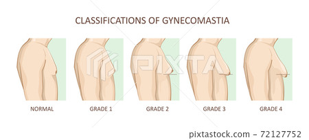 Classification of gynecomastia. Enlargement of the male breast 72127752