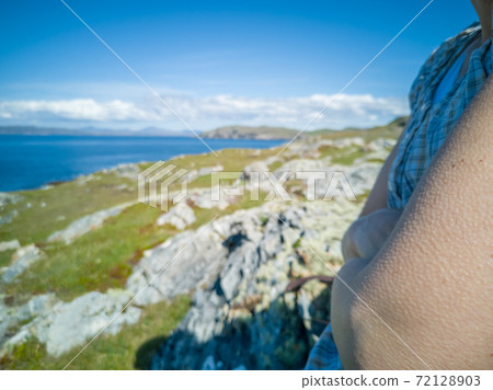 Human skin with goosebumps from the cold Human skin with goosebumps from the cold 72128903