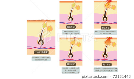 痤瘡圖的類型 痤瘡圖的類型 72151443
