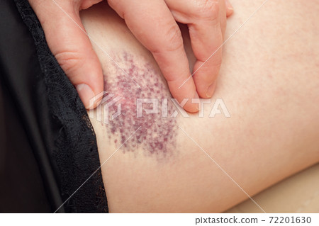 Young woman in black nightie with lace touches large bruise 72201630