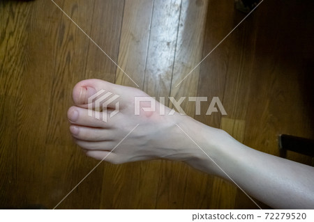 Insect bites 72279520