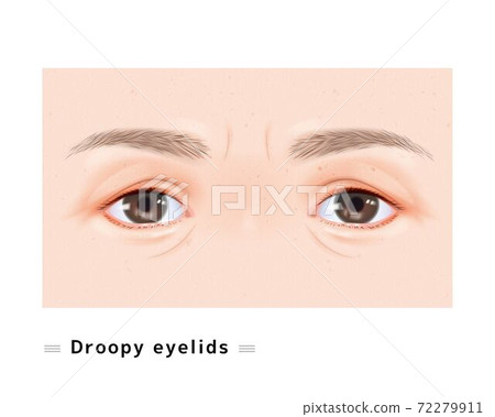眼瞼下垂雙眼皺紋細皺紋女性面部眼睛困眼瞼下垂眼科病例圖 72279911