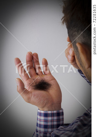 Hair loss Hair loss 72281635