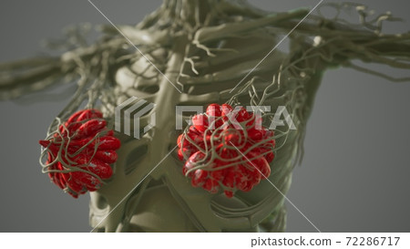 medical scan of Woman Breast Cancer medical scan of Woman Breast Cancer 72286717