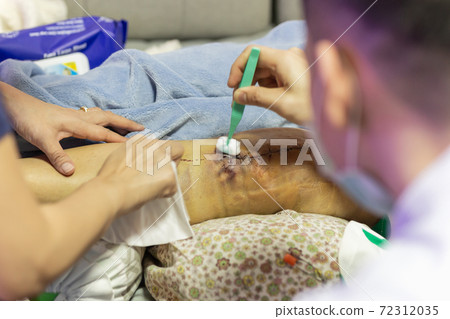 Doctor cleaning knee of patient after surgery with alcohol. Doctor cleaning knee of patient after surgery with alcohol. 72312035