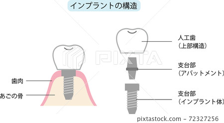 Implant structure 72327256