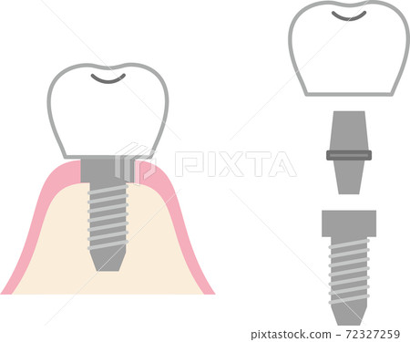 Implant structure Implant structure 72327259