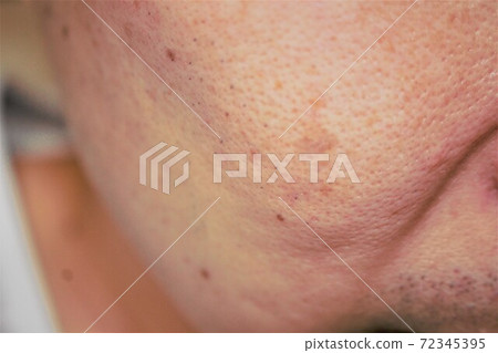 Dripping skin on the cheeks of men 72345395