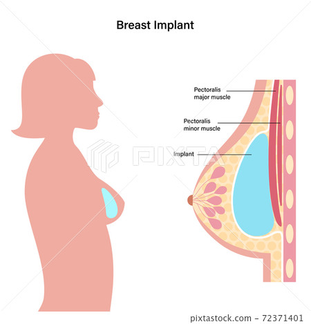 Breast Implant Concept Breast Implant Concept 72371401