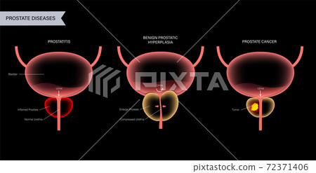 Prostate cancer concept Prostate cancer concept 72371406