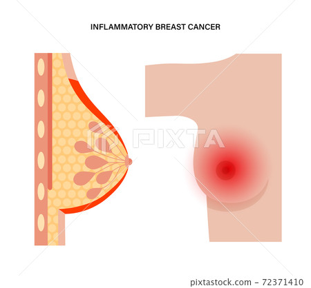 Breast disease concept 72371410