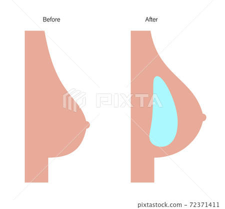 Breast Implant Concept 72371411