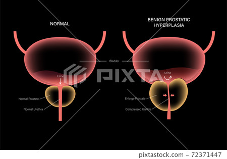 BPH info concept BPH info concept 72371447