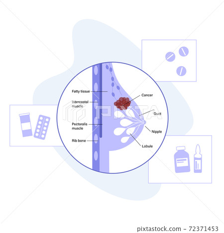 Breast disease concept 72371453