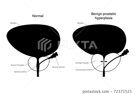 BPH info concept - Stock Illustration [72371525] - PIXTA