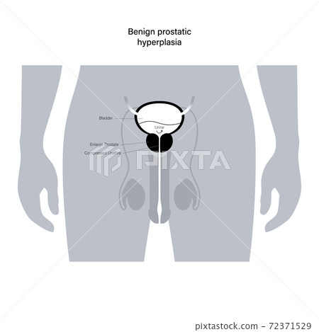 BPH info concept BPH info concept 72371529
