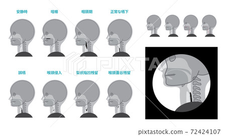 VF_Swallowing contrast examination illustration material set 72424107