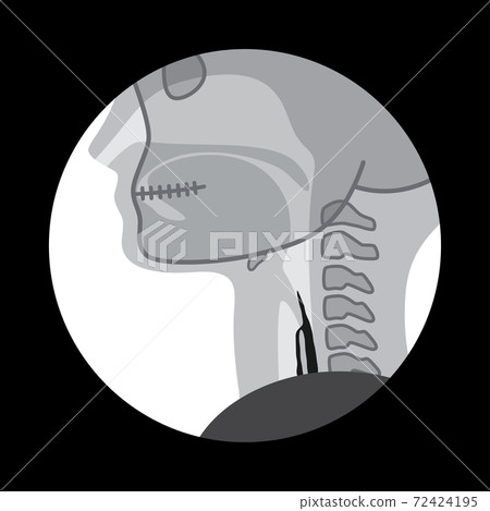 VF_Illustration of swallowing contrast examination_Aspiration 72424195