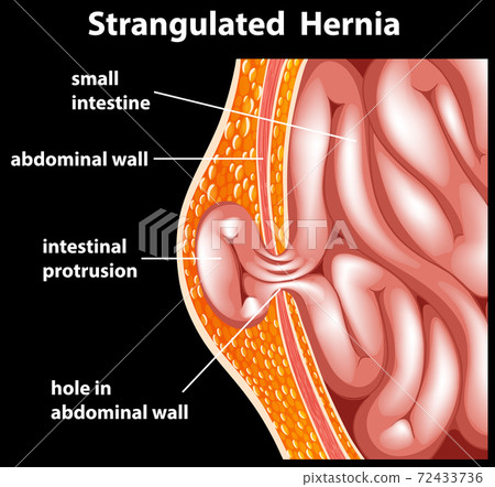 Strangulated Hernia Diagram for Education 72433736