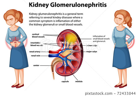 Medical infographic of kidney glomerulosclerosis Medical infographic of kidney glomerulosclerosis 72433844