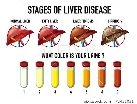 Stages of liver disease - Stock Illustration [72435831] - PIXTA