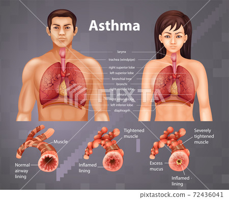 Comparison of healthy lung and Asthmatic lung 72436041