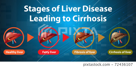Stages of liver disease leading to Cirrhosis Stages of liver disease leading to Cirrhosis 72436107