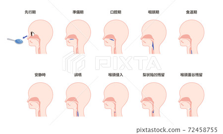 Illustration set of swallowing process and aspiration findings 72458755