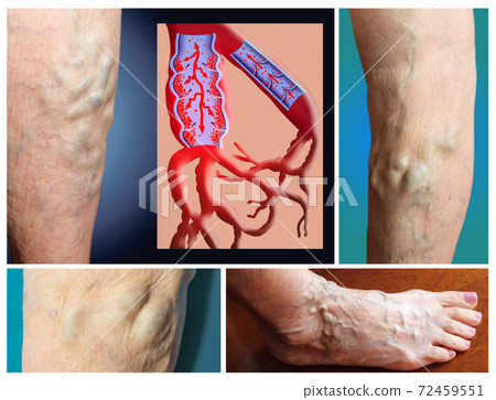 Varicose veins on a female senior legs. The structure of normal and varicose veins. Varicose veins on a female senior legs. The structure of normal and varicose veins. 72459551